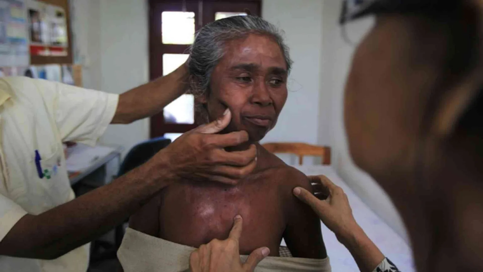 Lebbra, è ancora l'India il Paese più colpito. Anche in Europa nuovi casi