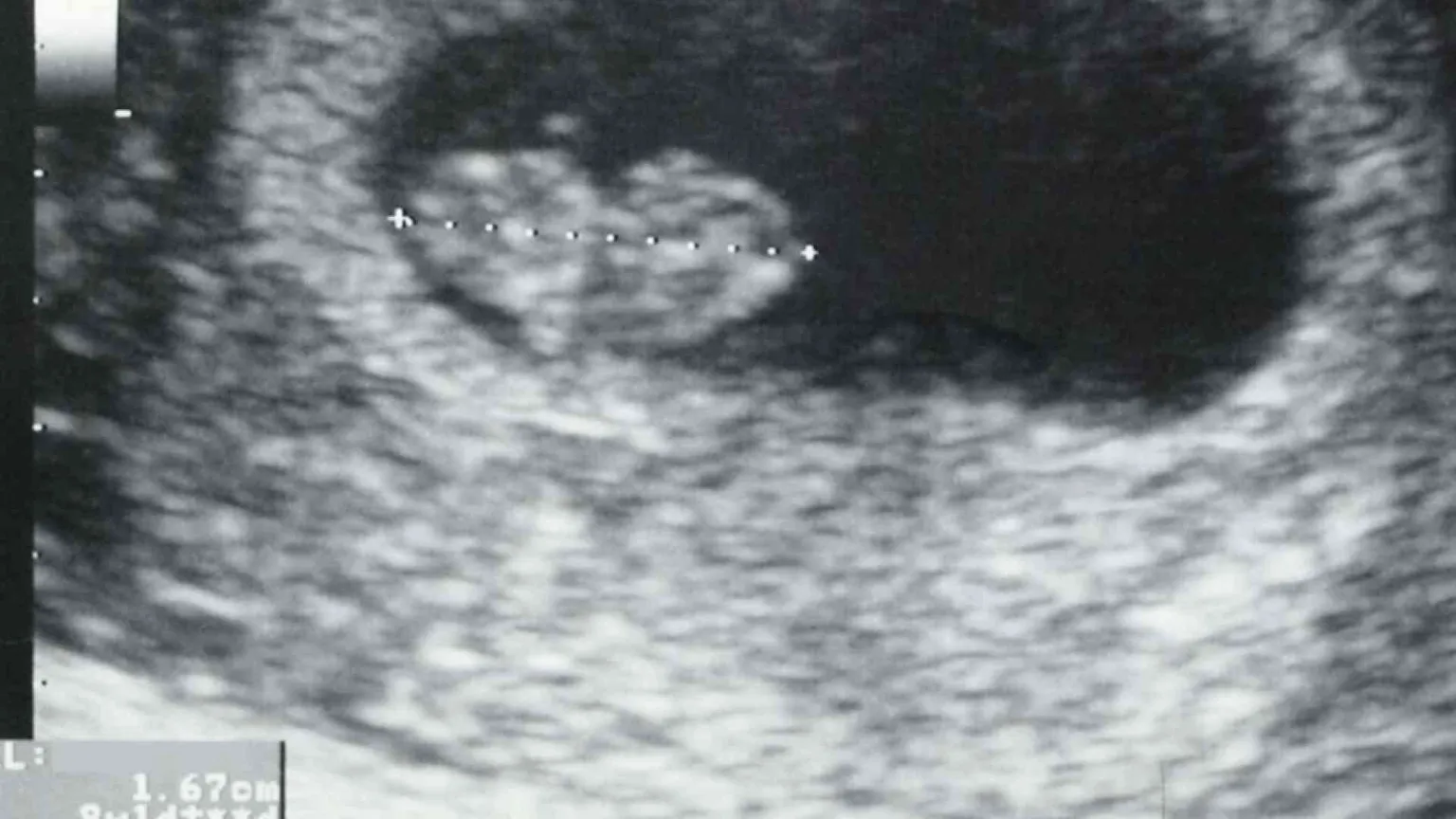 Aborto, sul battito del feto una polemica elettorale