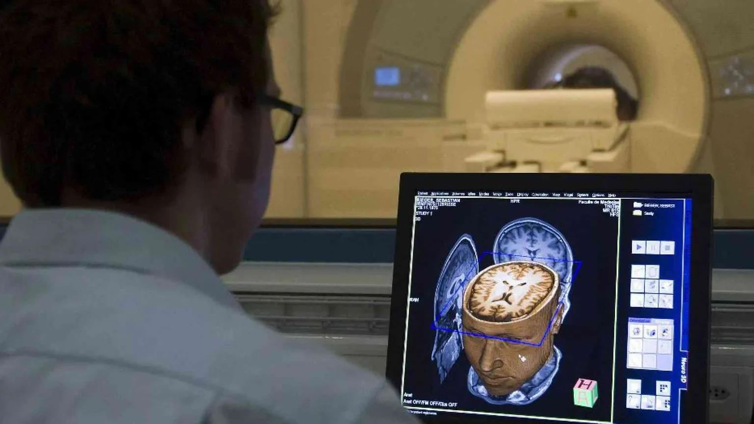 Malato di Sla parla grazie a un lettore collocato nel cervello