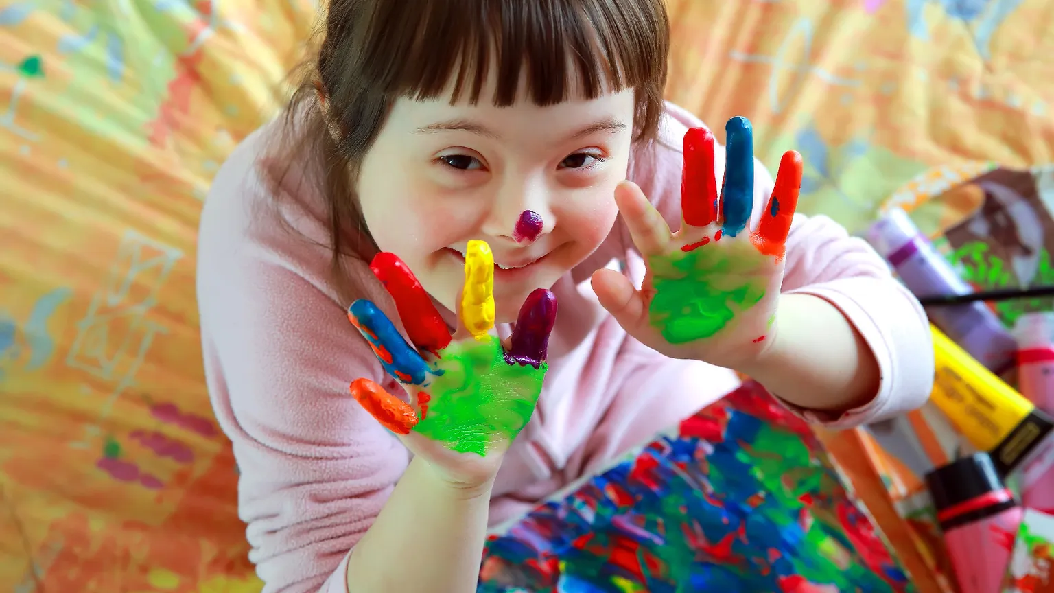 Sindrome di Down, una scoperta italiana può dare la svolta