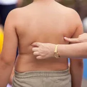 Epidemia di obesità, come si ferma?