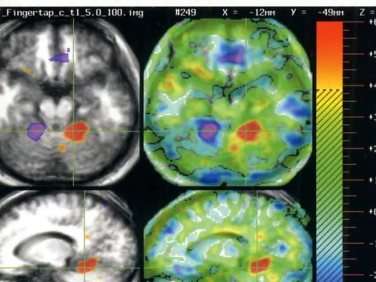 In stato vegetativo da 15 anni, recupera stato di minima coscienza