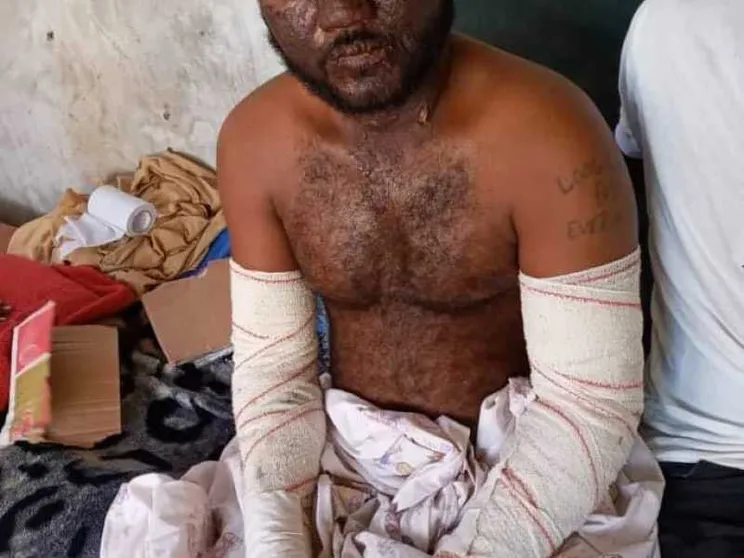 Ustionati in mare, la Libia li lascia "liberi". In carcere i sani