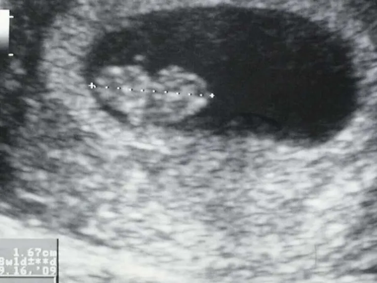 Aborto, sul battito del feto una polemica elettorale