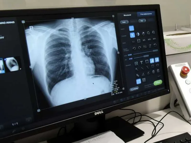 Nuove cure per i tumori al polmone: rischio di morte ridotta dell'84%