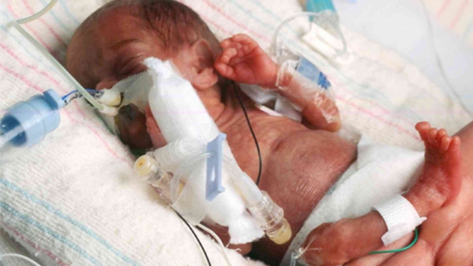 Gloria, nata alla 26esima settimana e salvata dai medici