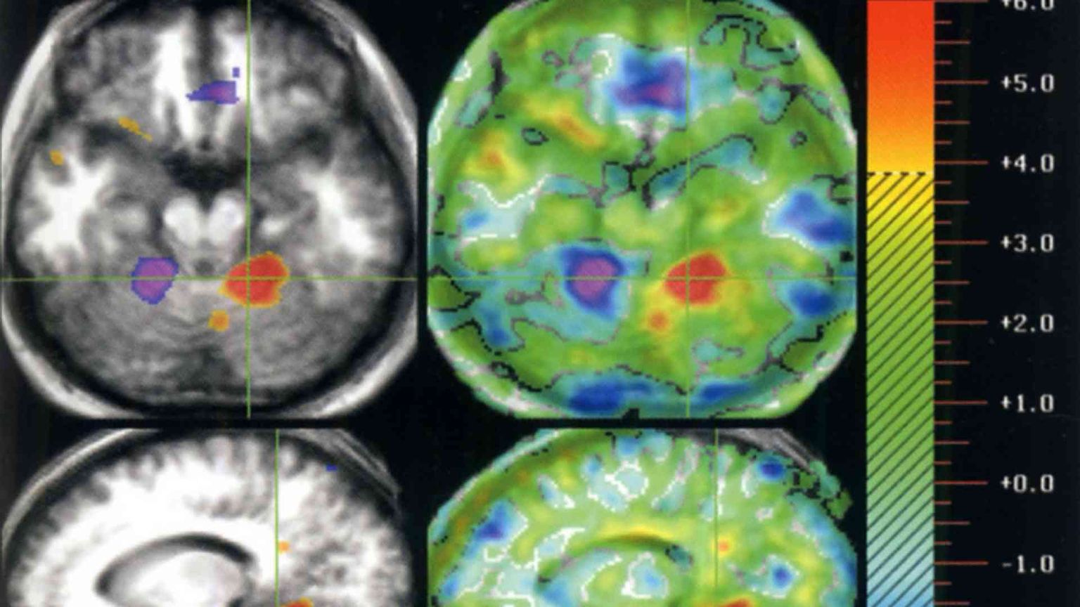 In stato vegetativo da 15 anni, recupera stato di minima coscienza