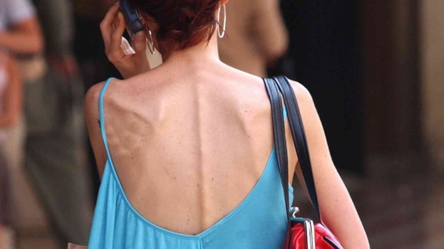 Un male che colpisce più di 3 milioni di persone. Ecco come riconoscerlo