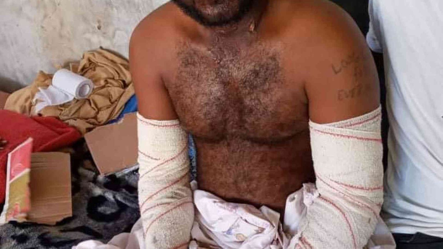 Ustionati in mare, la Libia li lascia "liberi". In carcere i sani