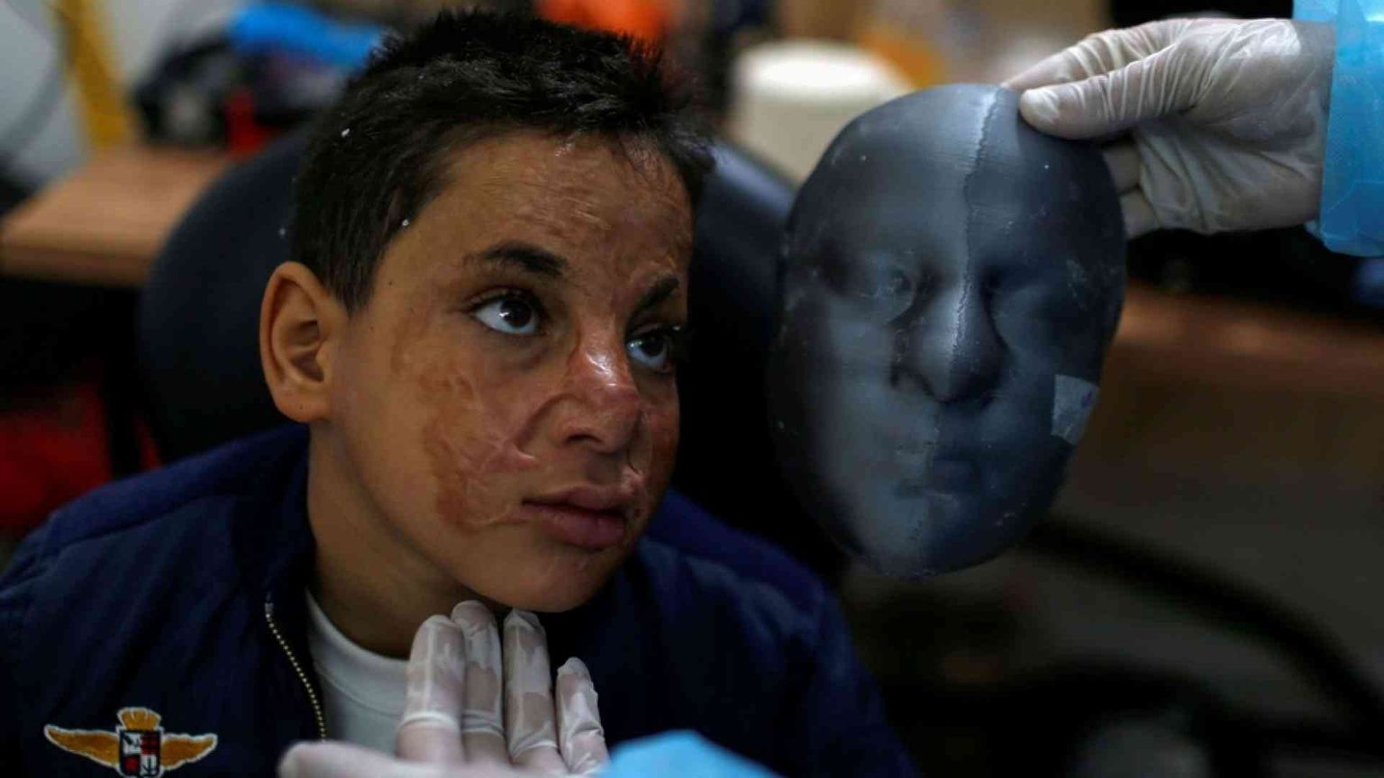 Scampati a un incendio, curati con maschere antiustioni stampate in 3D