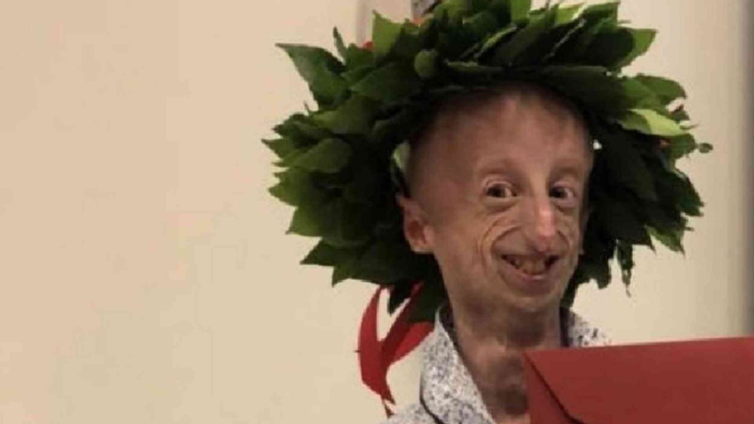 Seconda laurea per Sammy Basso, affetto da progeria