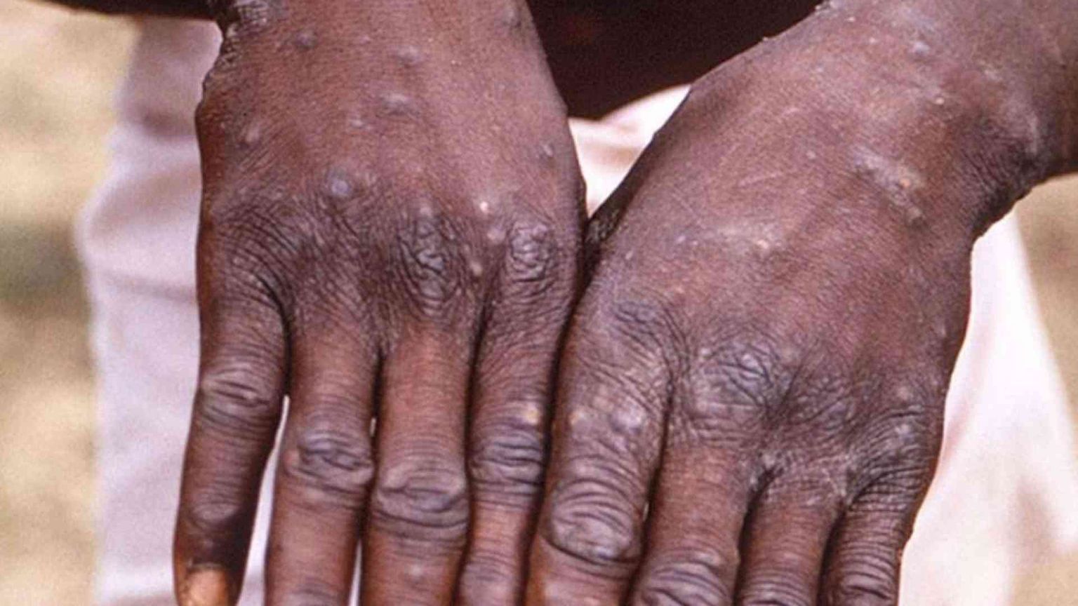 Vaiolo delle scimmie, confermati oltre mille casi. In Usa individuato nuovo ceppo