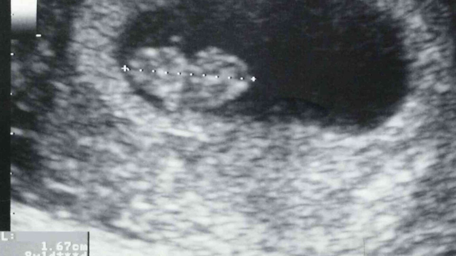 Aborto, sul battito del feto una polemica elettorale