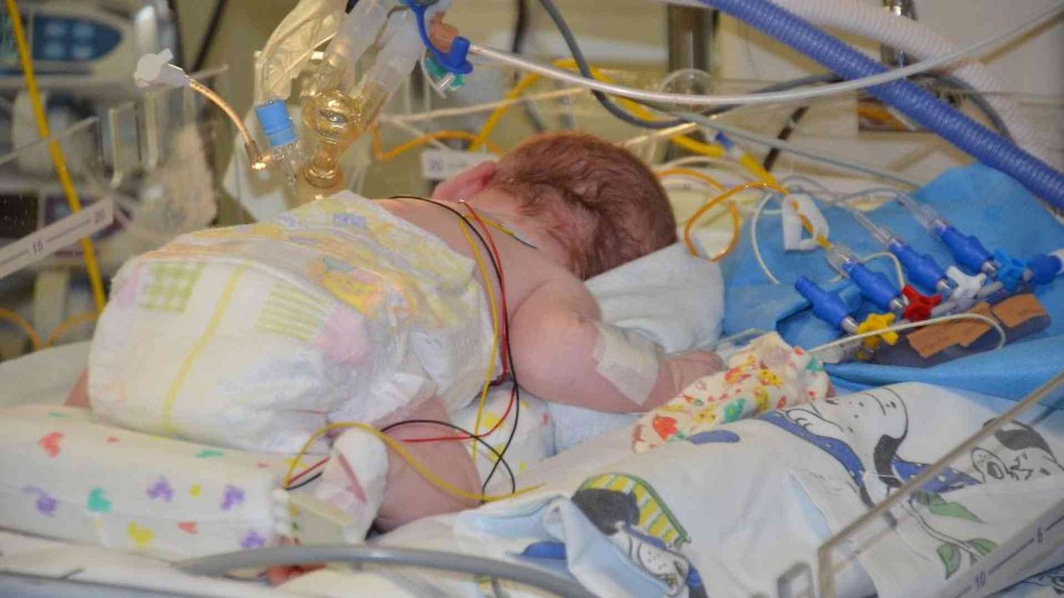 La bioingegneria ferma la spina bifida