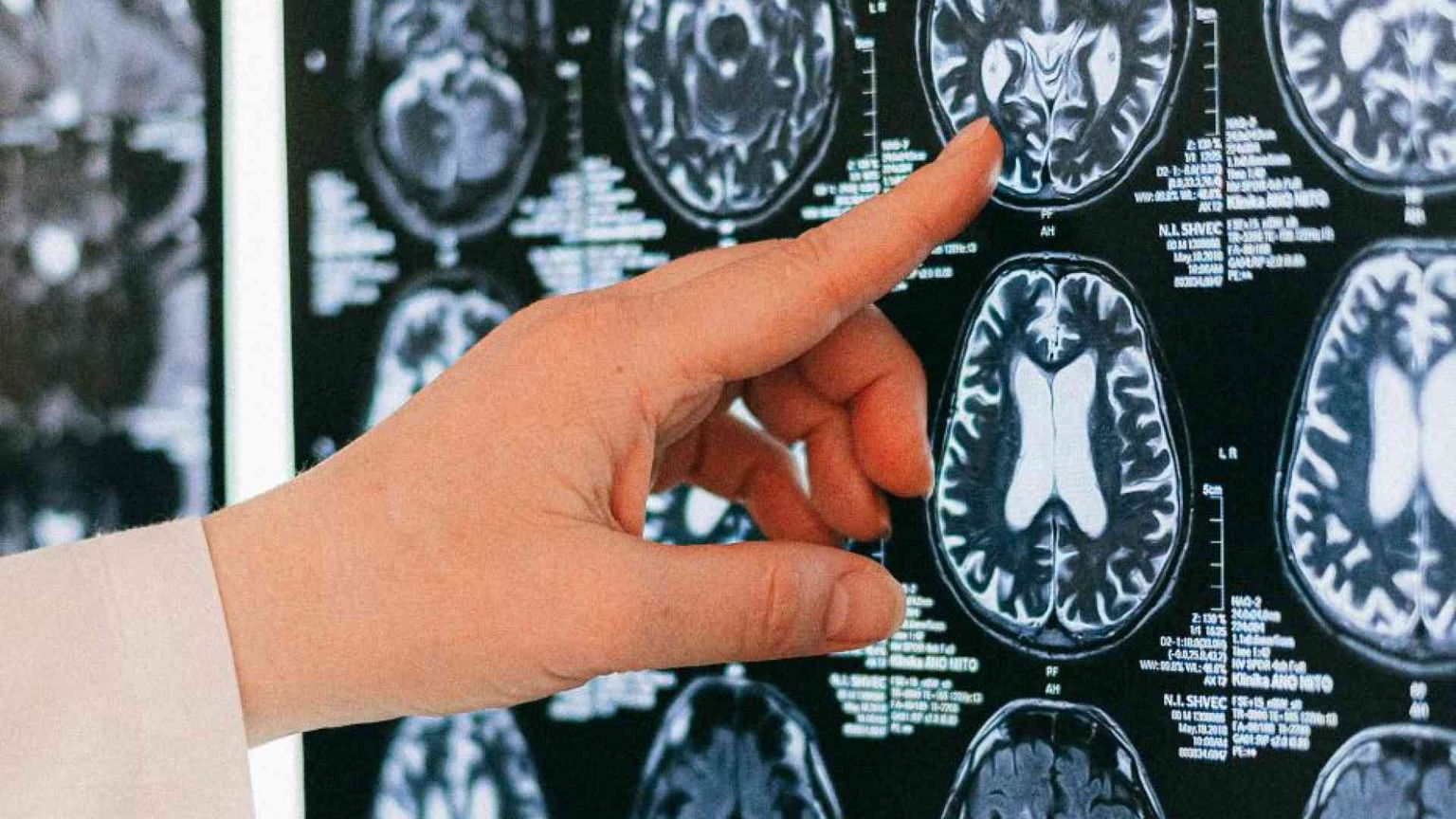 Sintomi, prevenzione, terapie: cosa c’è da sapere sull’ictus