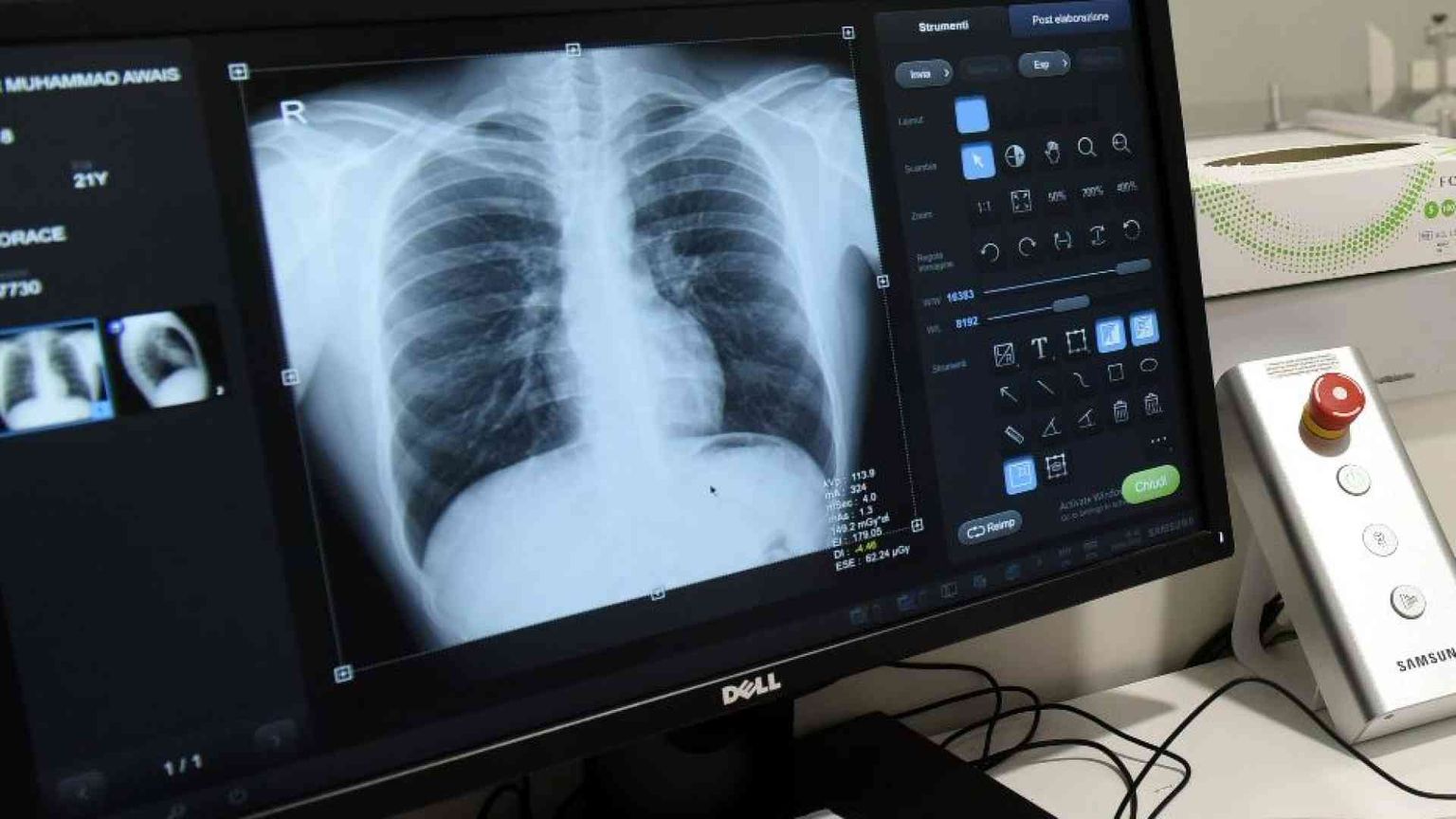 Nuove cure per i tumori al polmone: rischio di morte ridotta dell'84%