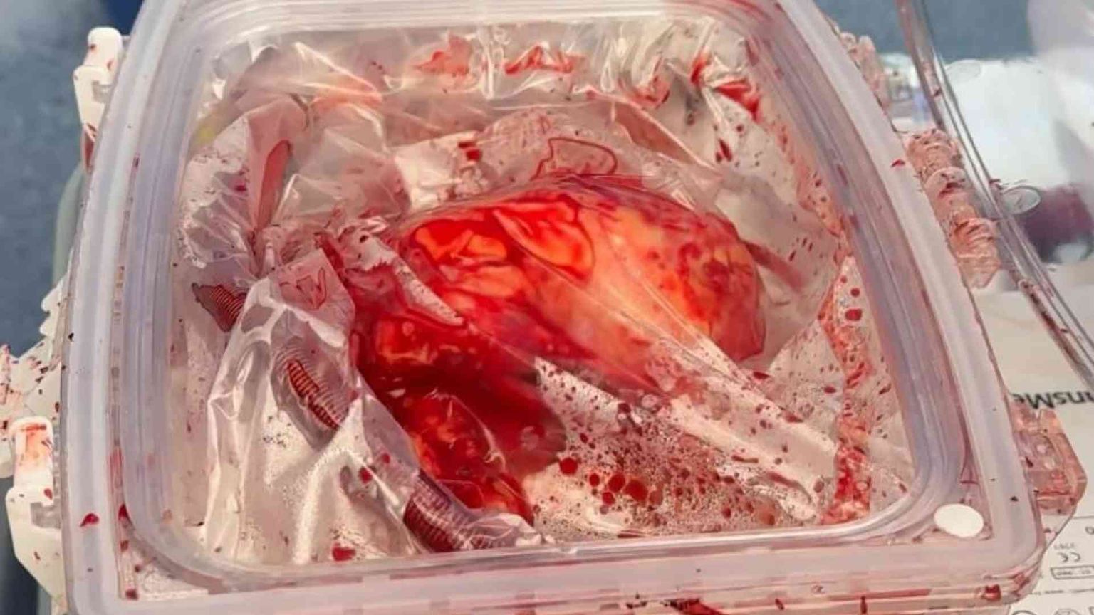 È stato trapiantato un cuore sempre battente, dal prelievo all'impianto