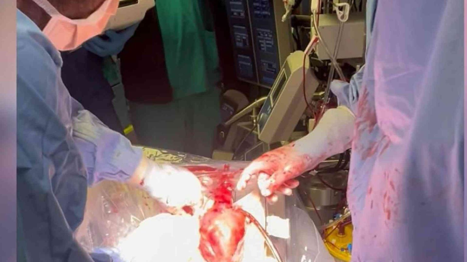 Perché il trapianto “a cuore battente” non crea problemi etici