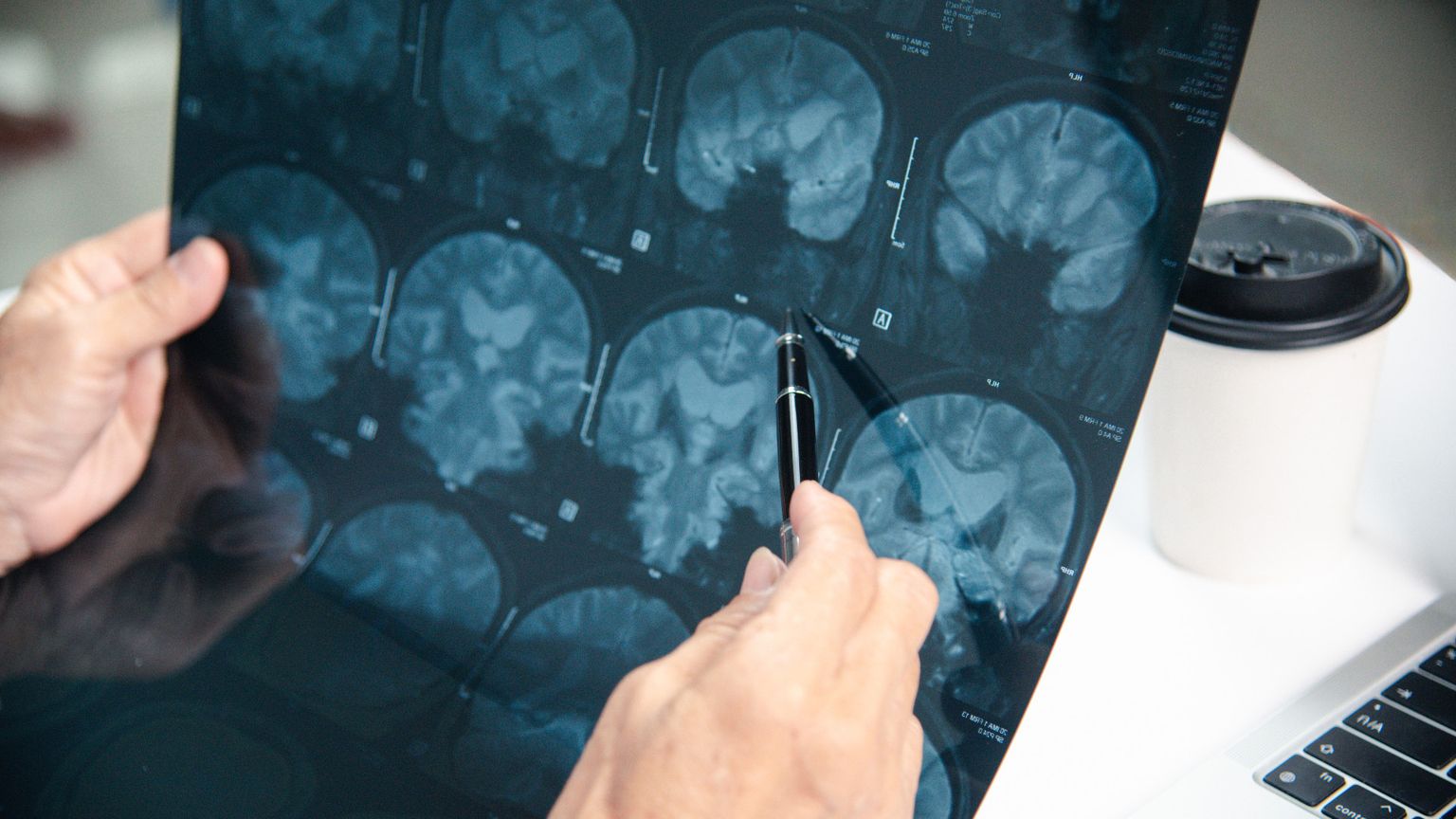 La nuova tecnologia di Rilemo: diagnosi di ictus in 5 secondi