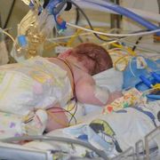 La bioingegneria ferma la spina bifida