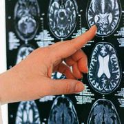 Sintomi, prevenzione, terapie: cosa c’è da sapere sull’ictus