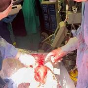 Perché il trapianto “a cuore battente” non crea problemi etici