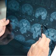 La nuova tecnologia di Rilemo: diagnosi di ictus in 5 secondi