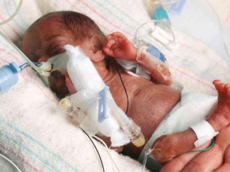 Gloria, nata alla 26esima settimana e salvata dai medici