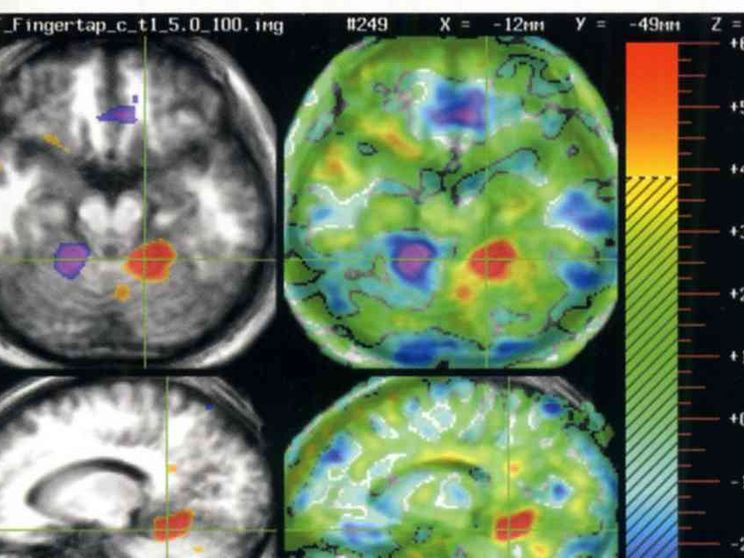 In stato vegetativo da 15 anni, recupera stato di minima coscienza