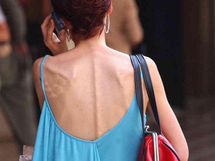 Un male che colpisce più di 3 milioni di persone. Ecco come riconoscerlo