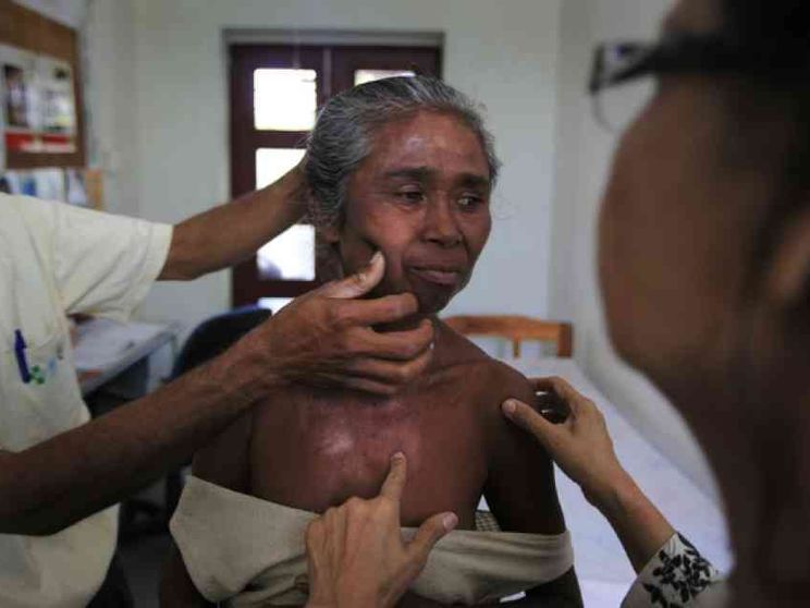 Lebbra, è ancora l'India il Paese più colpito. Anche in Europa nuovi casi