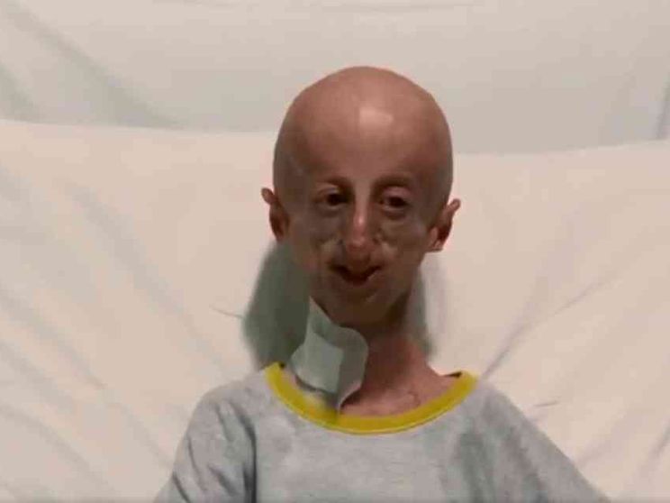 Sammy Basso, malato di progerie, parla dopo l'intervento al cuore