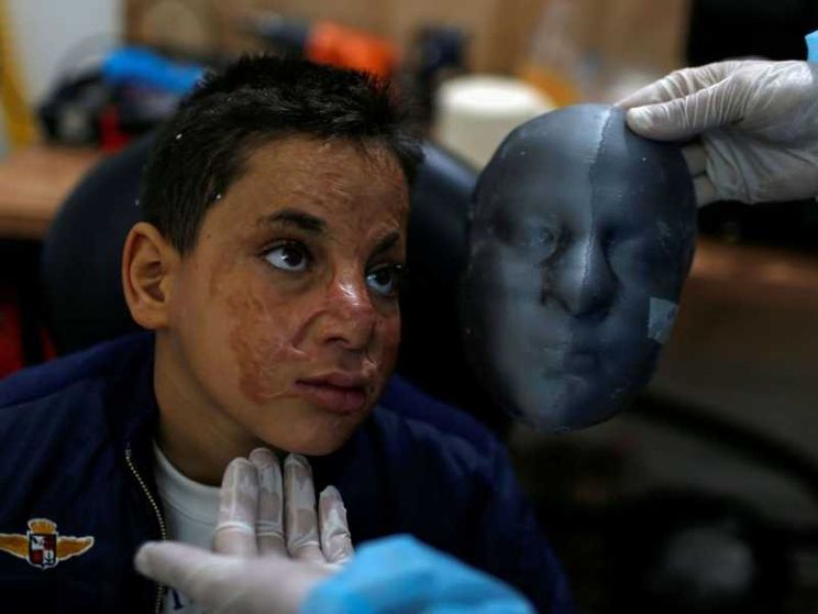Scampati a un incendio, curati con maschere antiustioni stampate in 3D