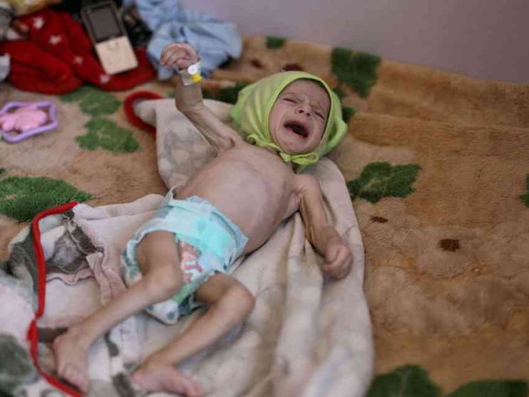 Yemen, rischio malnutrizione cronica per metà dei bambini sotto i 5 anni