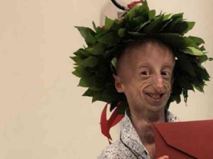 Seconda laurea per Sammy Basso, affetto da progeria