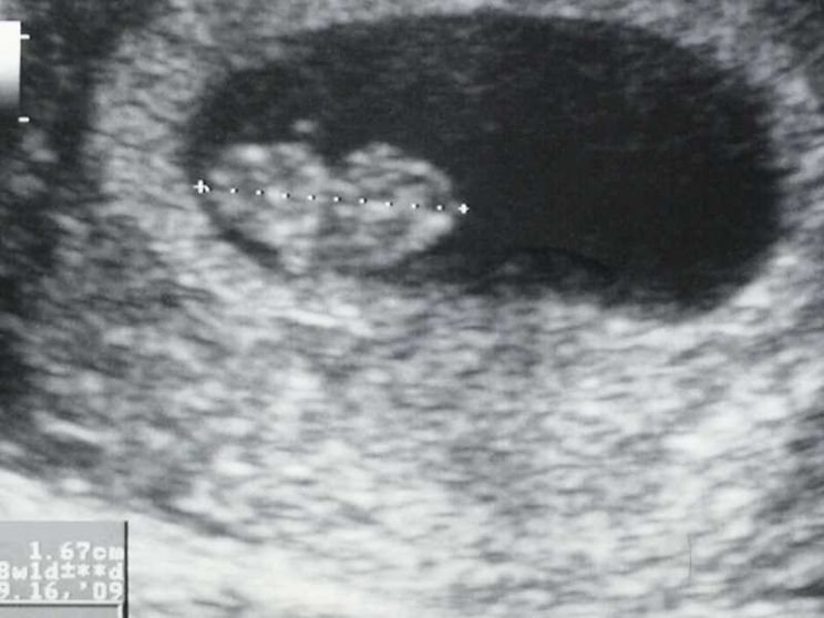 Aborto, sul battito del feto una polemica elettorale