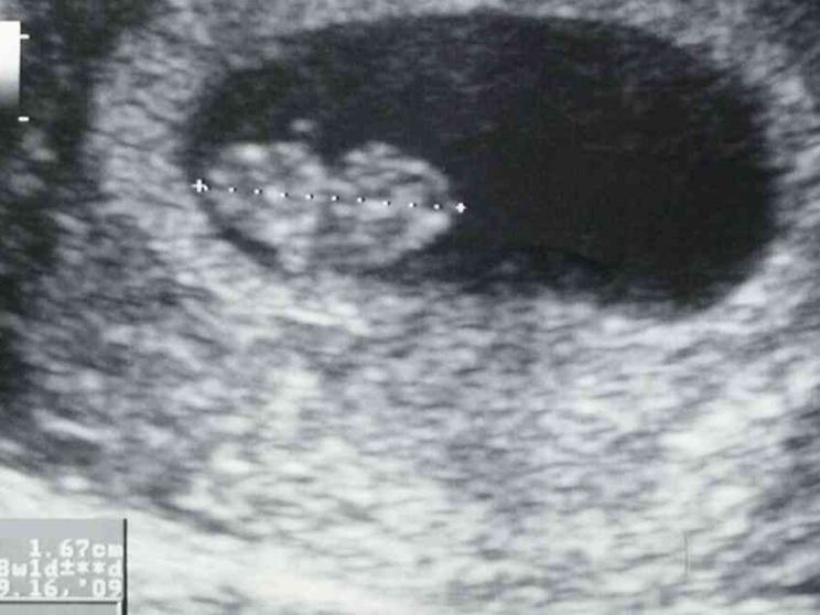 Aborto, sul battito del feto una polemica elettorale