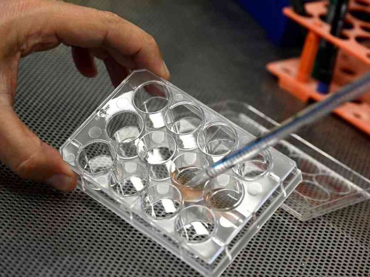 Sclerosi multipla, «risultati positivi» da trapianto di staminali nel cervello