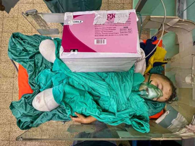 La tragedia di Gaza nella foto del bambino con le gambe amputate