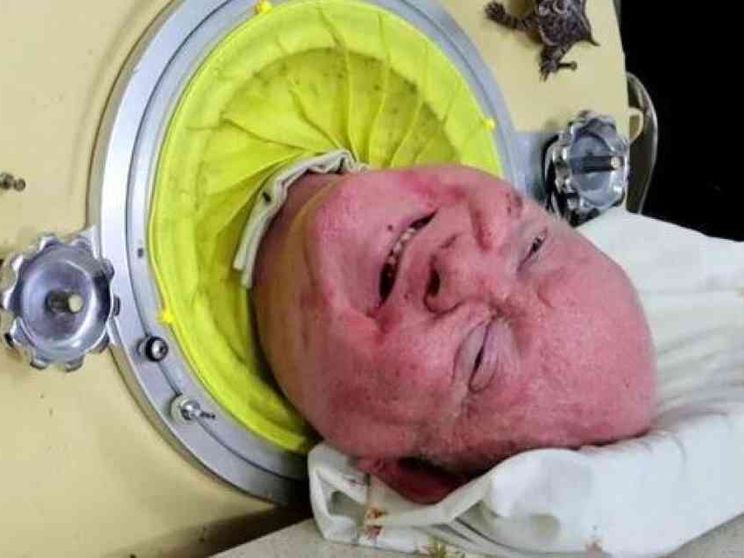 Addio a Paul Alexander, dopo 70 anni di «vita piena» in un polmone d'acciaio