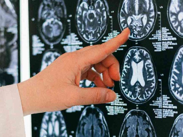 Sintomi, prevenzione, terapie: cosa c’è da sapere sull’ictus