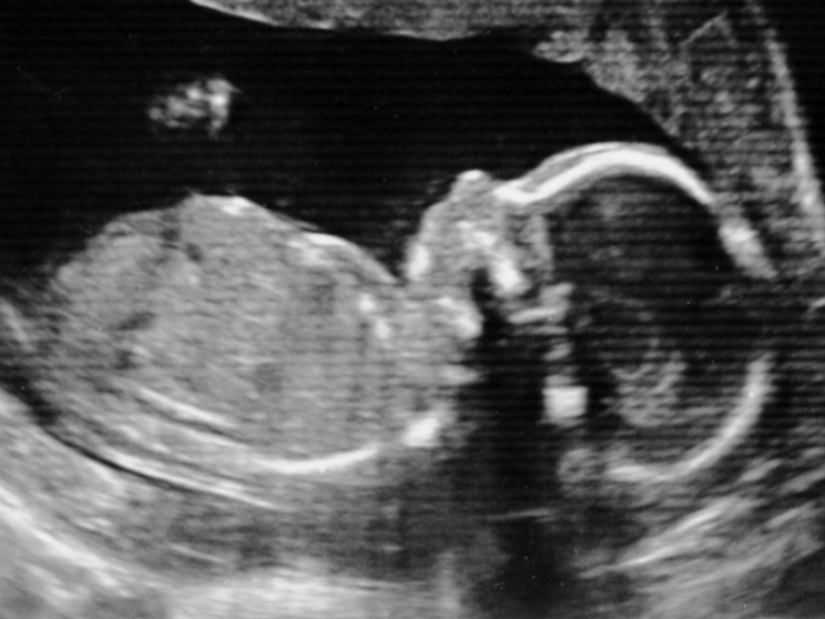 L’ecografia che zittisce e il silenzio sulle nostre ipocrisie