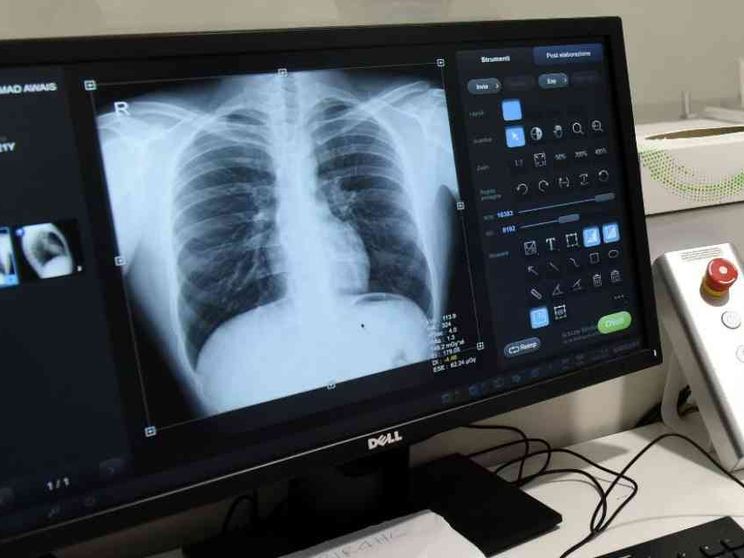 Nuove cure per i tumori al polmone: rischio di morte ridotta dell'84%