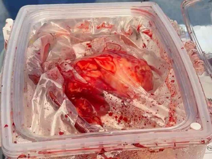 È stato trapiantato un cuore sempre battente, dal prelievo all'impianto