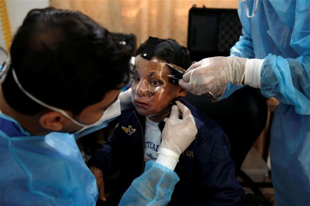 Gli ultimi aggiustamenti alla maschera terapeutica nella clinica di Gaza