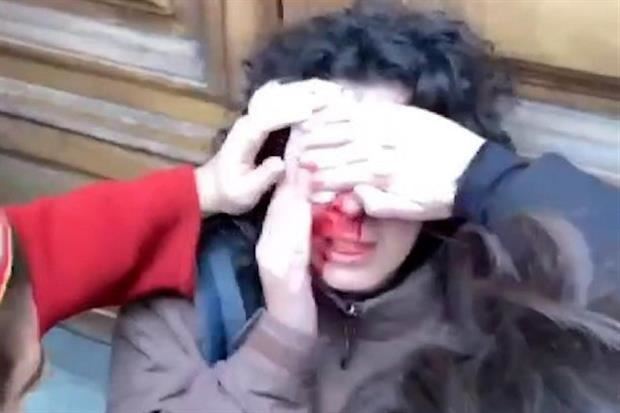 La ragazza ferita per un colpo al naso al corteo di Firenze