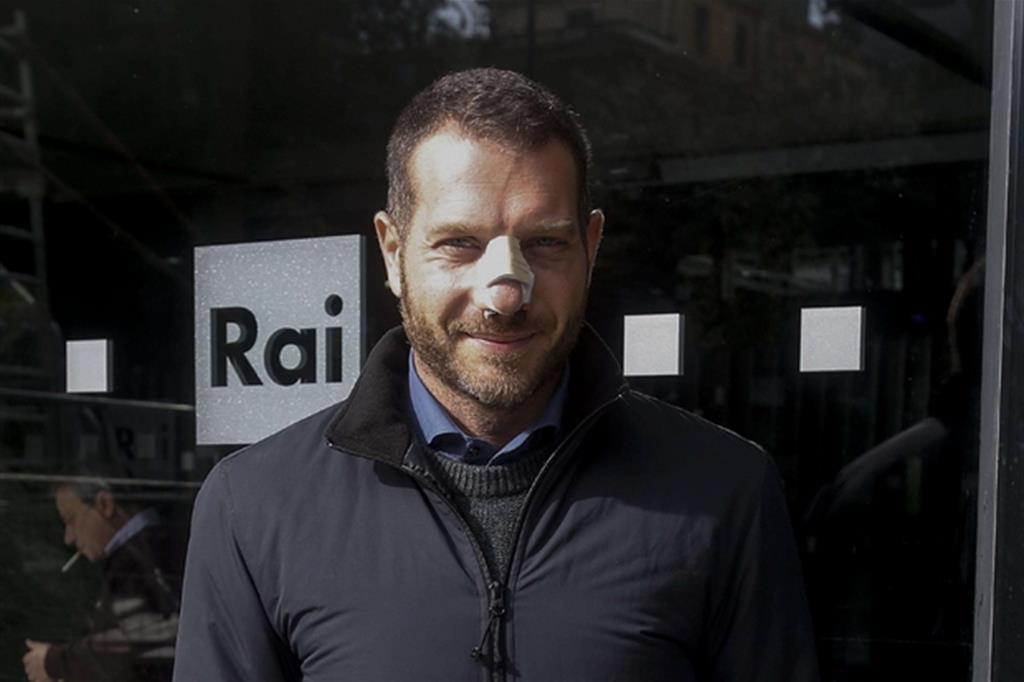 Il giornalista Daniele Piervincenzi incerottato dopo l'aggressione di Ostia