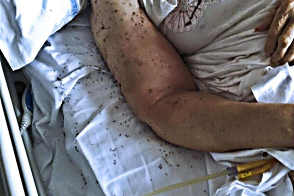 Formiche nel letto di ospedale, Lorenzin: «Fatto indegno, inviata task force»