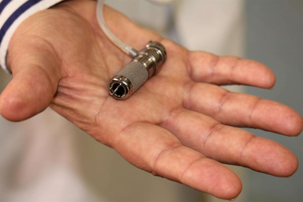 Il mini-cuore artificiale impiantato sulla piccola