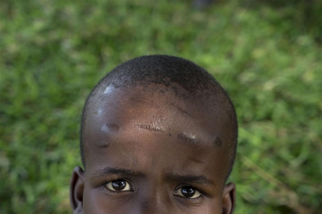 Una bambina affetta da macrocefalia. Per cercare di risolvere il problema il “witch doctor” nelle foreste ha eseguito incisioni sul cranio (foto di Carolina Paltrinieri)